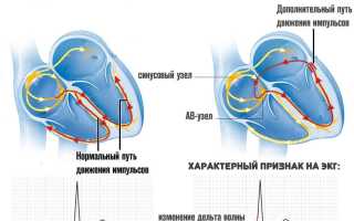 Синдром впв опасен или нет