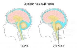 Прогрессирует ли синдром арнольда киари