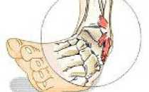 Ушиб растяжение код мкб