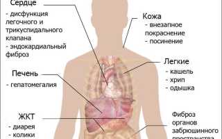 Карциноидный синдром у кого был