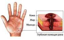 Код мкб колото резанная рана