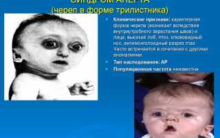 Синдром аперта что это такое