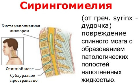 Прогрессирует ли синдром арнольда киари