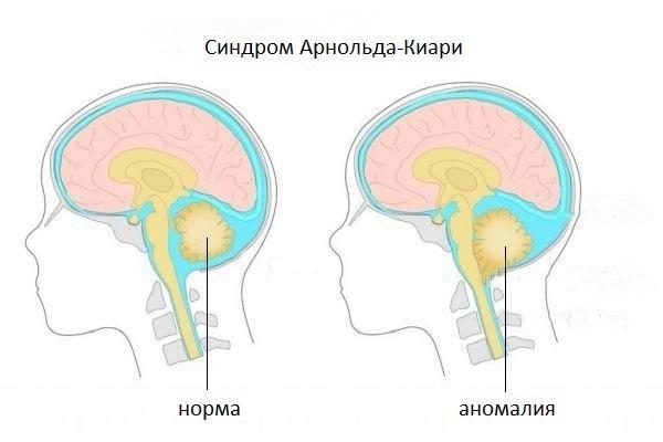 Прогрессирует ли синдром арнольда киари