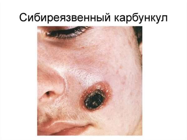 Фурункул спины код мкб