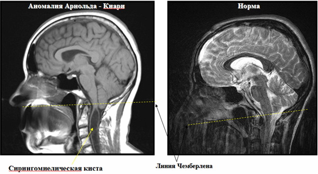 Прогрессирует ли синдром арнольда киари