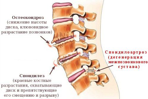 Заболевания, которые сопровождаются вертеброгенной болью в груди