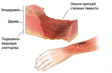 Ожоги причины симптомы первая помощь