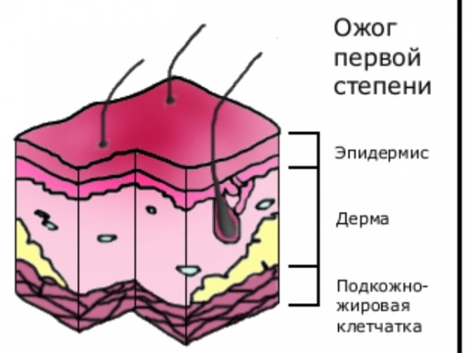 1 СТ Ожог и первая помощь в отдаленной местности!