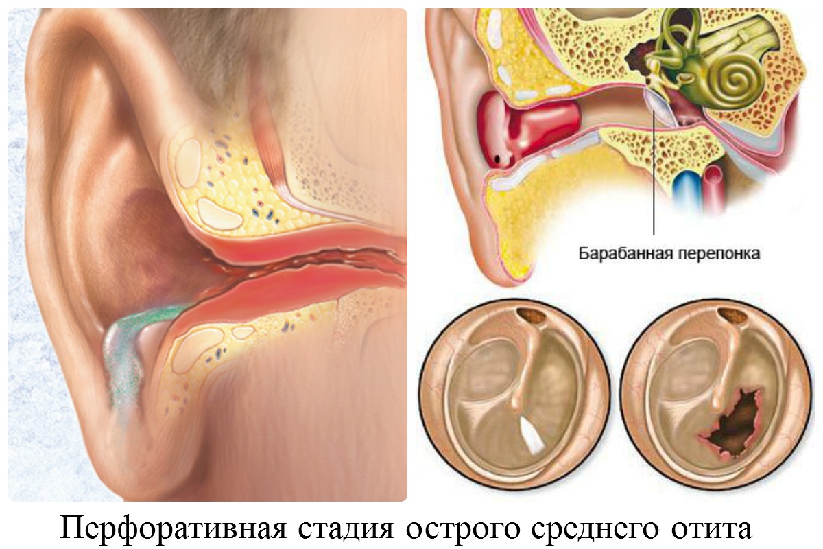 Лечение острого гнойного отита среднего уха