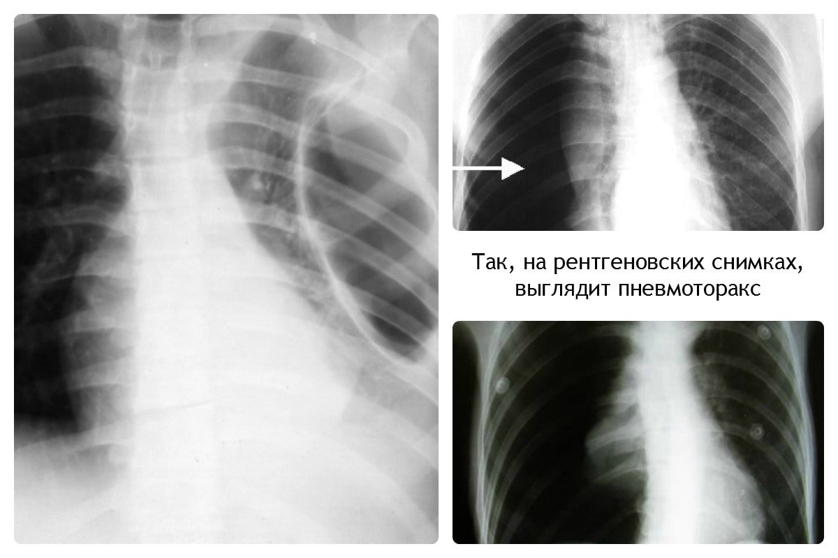Пневмоторакс