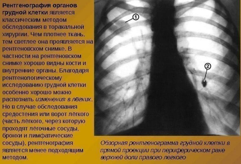 Рентген грудной клетки для диагностики пневмонии