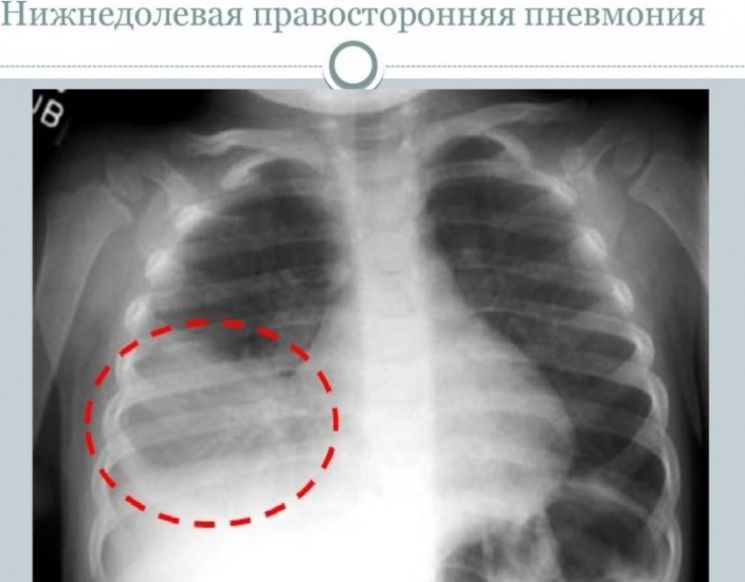 Лечение пневмонии картинки у детей