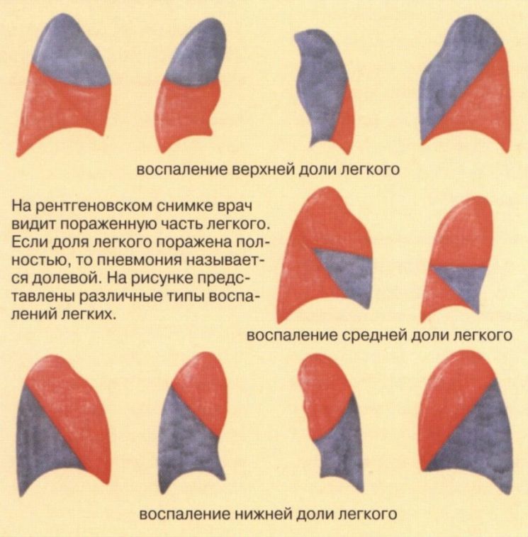 Лечение пневмонии картинки у детей