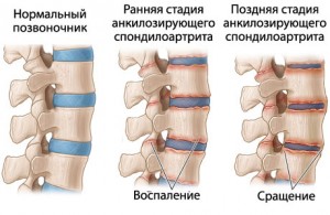 болезнь бехтерерва
