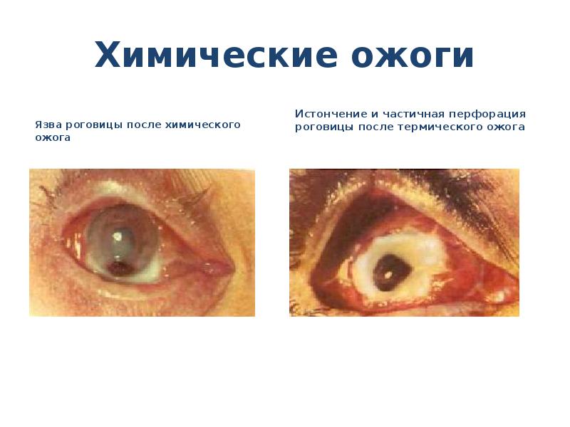 Химические ожоги
Язва роговицы после химического ожога
Ожоги глаз презентация скачать бесплатно