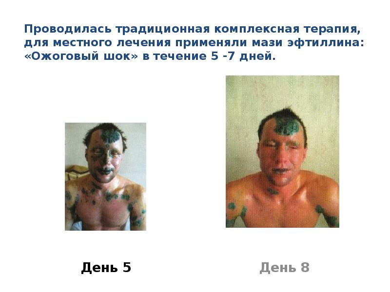 Проводилась традиционная комплексная терапия, для местного лечения применяли мази эфтиллина: «Ожоговый шок» в течение 5 -7 дней.
День 5
Ожоги глаз презентация скачать бесплатно