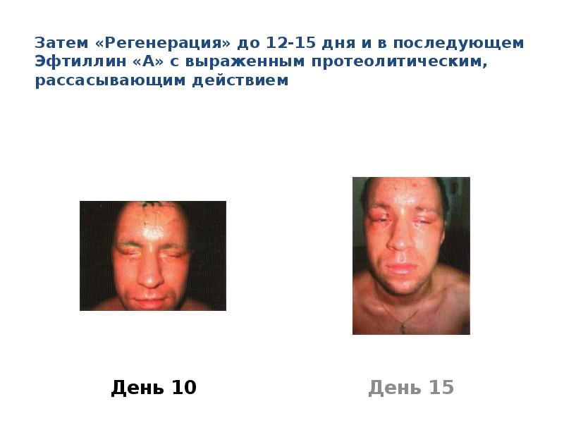 Затем «Регенерация» до 12-15 дня и в последующем Эфтиллин «А» с выраженным протеолитическим, рассасывающим действием
День 10
Ожоги глаз презентация скачать бесплатно