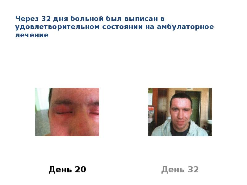 Через 32 дня больной был выписан в удовлетворительном состоянии на амбулаторное лечение
День 20
Ожоги глаз презентация скачать бесплатно