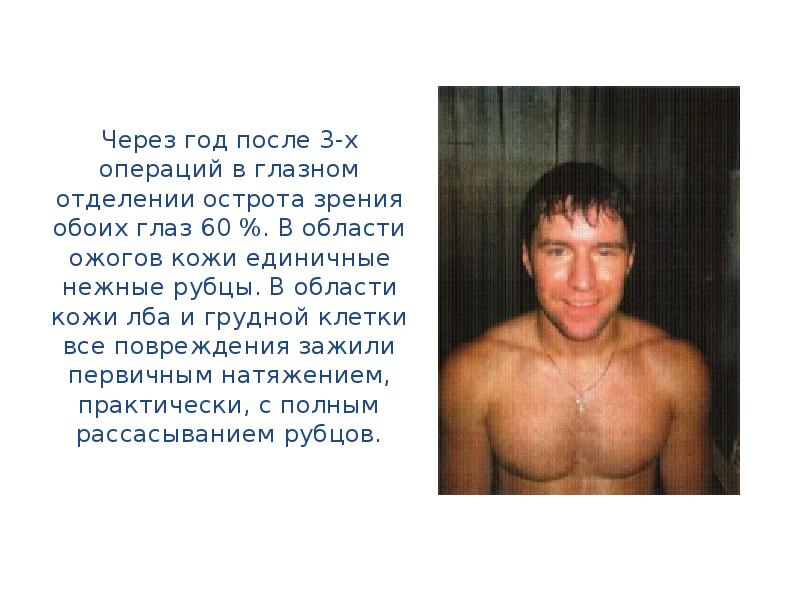 Через год после 3-х операций в глазном отделении острота зрения обоих глаз 60 %. В области ожогов кожи единичные нежные рубцы. В области кожи лба и грудной клетки все повреждения зажили первичным натяжением, практически, с полным рассасыванием рубцов. Ожоги глаз презентация скачать бесплатно