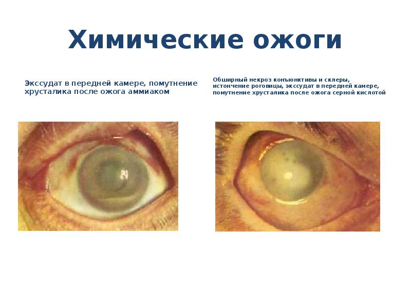 Химические ожоги
Экссудат в передней камере, помутнение хрусталика после ожога аммиаком
Ожоги глаз презентация скачать бесплатно