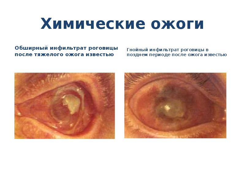 Химические ожоги
Обширный инфильтрат роговицы после тяжелого ожога известью
Ожоги глаз презентация скачать бесплатно