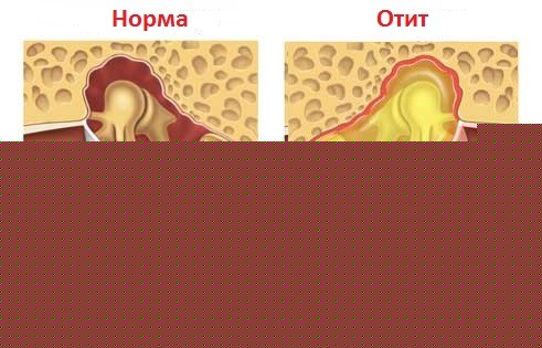 Хронический отит Хронический отит