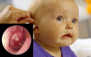 Отит у ребенка Отит у грудного ребенка