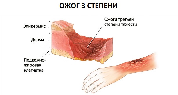 Химический ожог третей степени