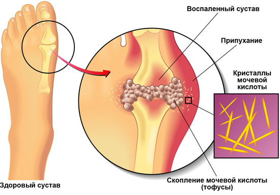 Подагра Подагра