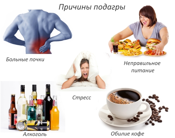 Частые причины подагры Частые причины подагры