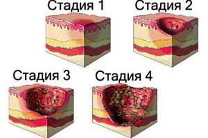 стадии формирования пролежней стадии формирования пролежней