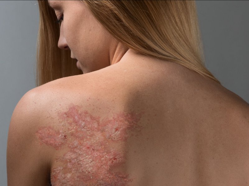 psoriaz-simptomy