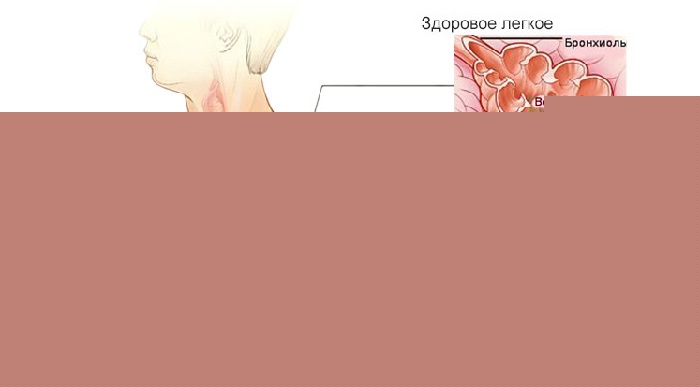 Воспаление легких
