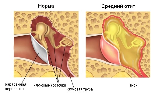 Скопление гноя в среднем ухе при гнойном отите Скопление гноя в среднем ухе при гнойном отите