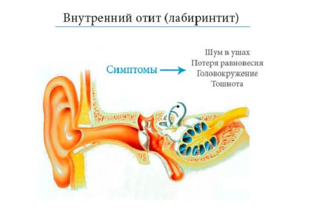 Лабиринтит